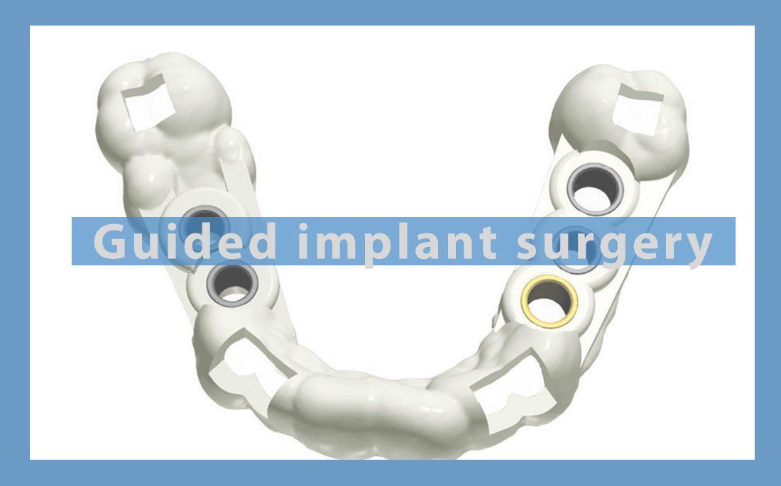 Vig-Guided-implant-surgery